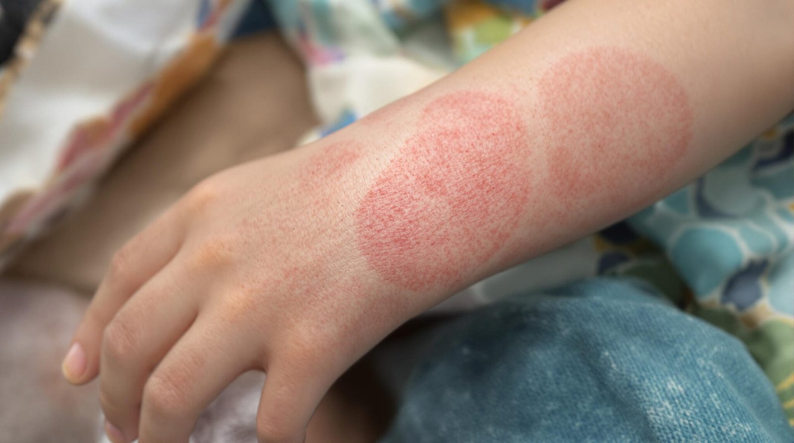 Skin rash with circular lesions on arm